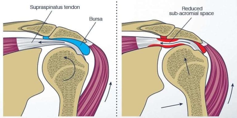 SINDROMUL DE IMPINGEMENT AL UMARULUI