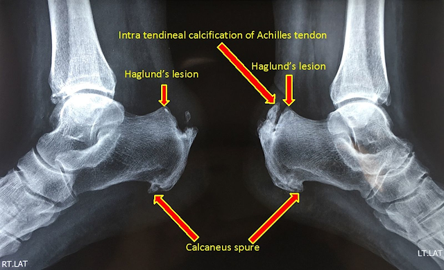Calcifierea tendonului achilean